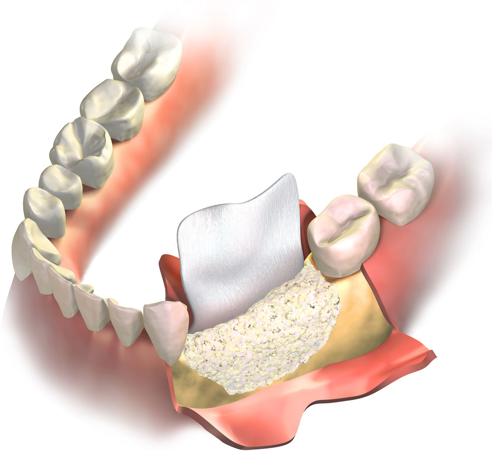 Render 3D Bone Regeneration