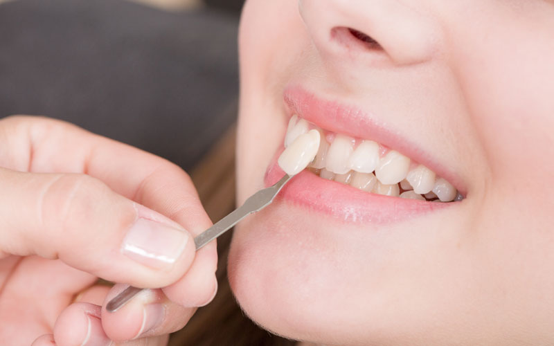 Close up ragazza che prova una faccetta dentale